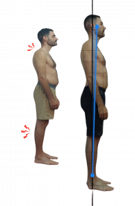 hipercifosis